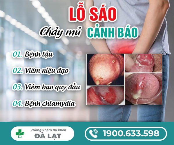 LỖ SÁO CHẢY MỦ: NGUYÊN NHÂN, TÁC HẠI VÀ PHƯƠNG PHÁP ĐIỀU TRỊ HIỆU QUẢ